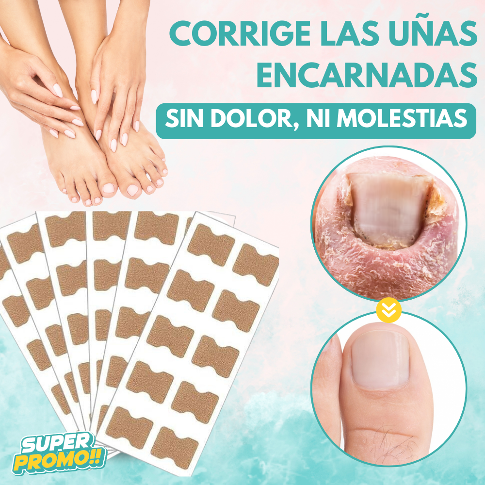 1+1 GRATIS UÑAFIX™ | REPARA LAS UÑAS ENCARNADAS SIN DOLOR