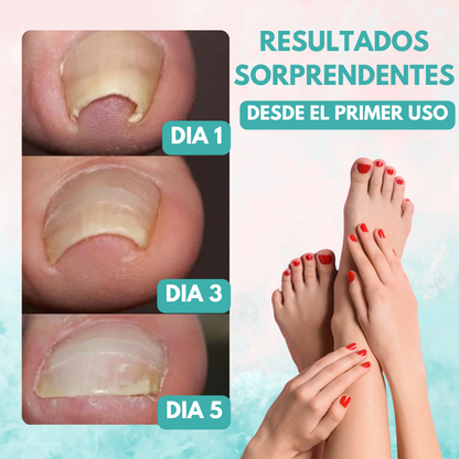 1+1 GRATIS UÑAFIX™ | REPARA LAS UÑAS ENCARNADAS SIN DOLOR